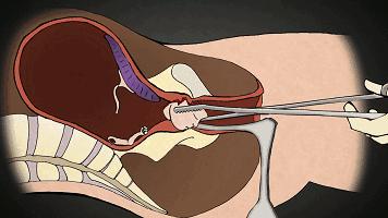流产和宫外孕哪个可怕,流产跟怀孕有什么关系