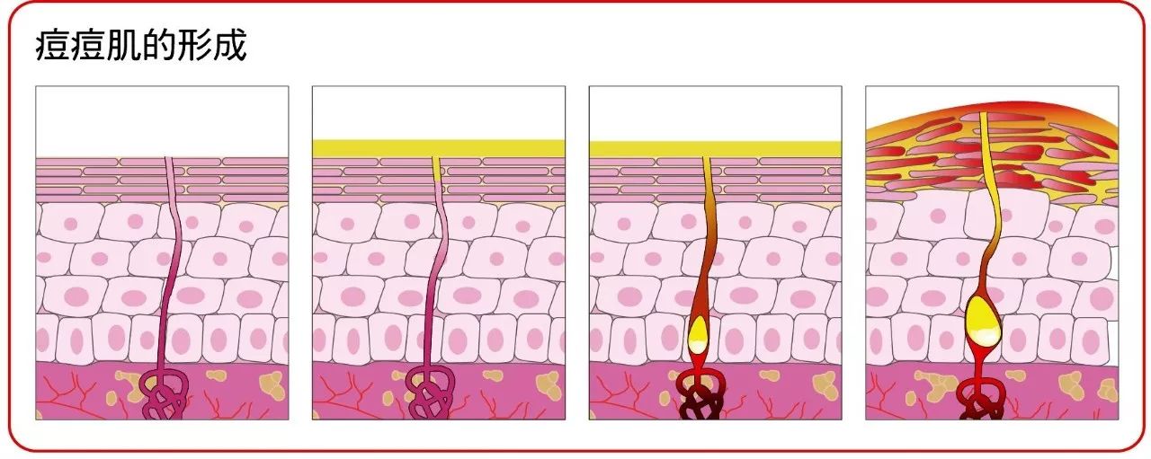 痘痘最怕的6个习惯,痘痘最害怕的三个克星