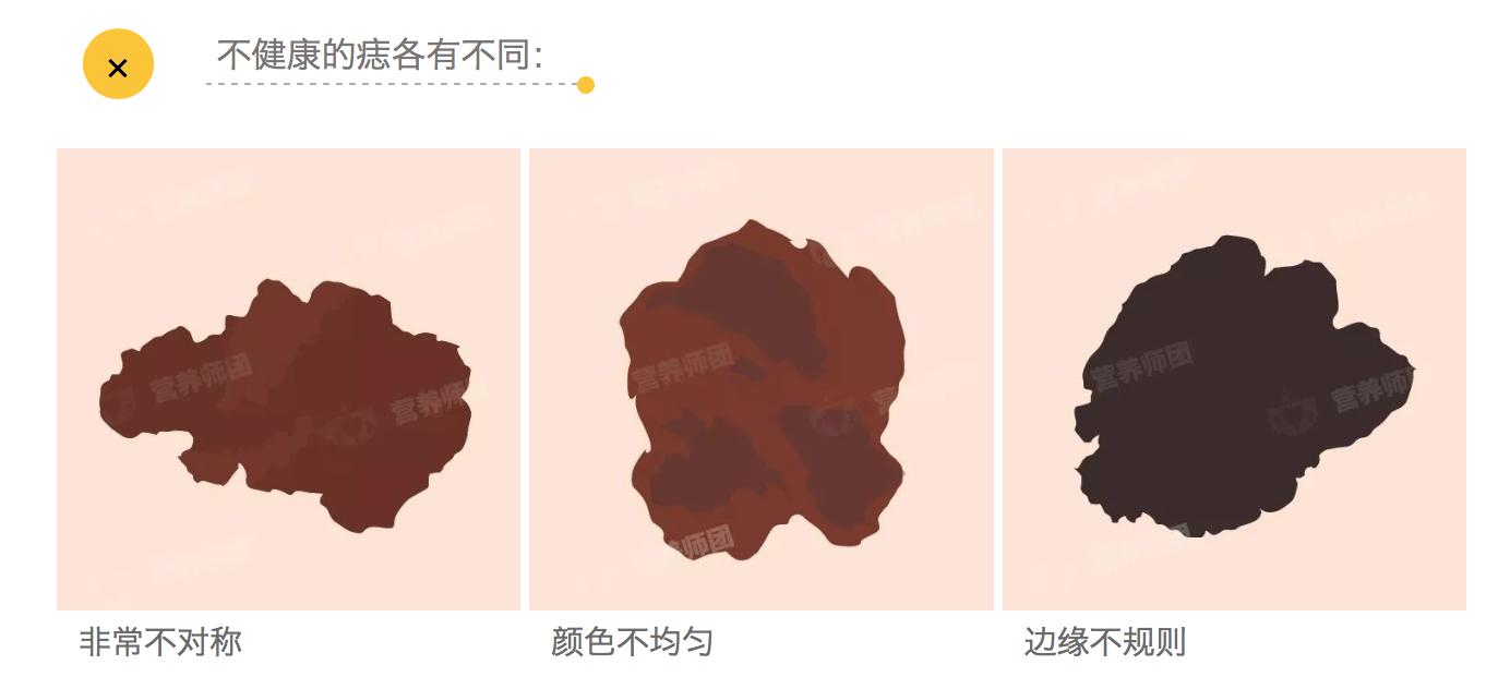 痣未结痂要擦药吗,痣没去干净会有影响吗