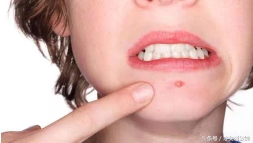 护肤处理闭合粉刺,谢敏婵的护肤品