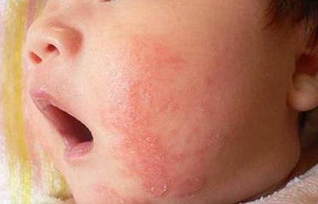 婴儿脸上疹子,婴儿疹子