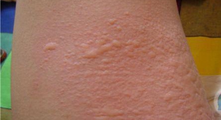 婴儿脸上疹子,婴儿疹子