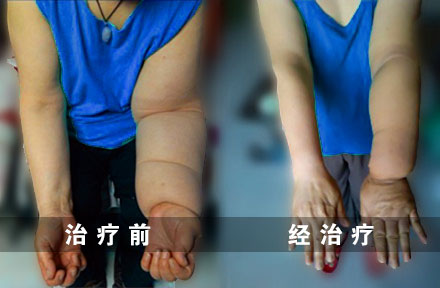 乳腺癌术后上肢水肿最新治疗方法,乳腺癌淋巴水肿案例分析