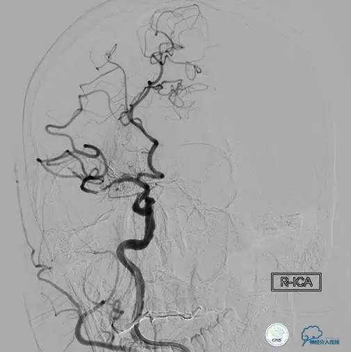 急性缺血性卒中静脉溶栓2018指南,急性缺血性卒中血管内再通标准