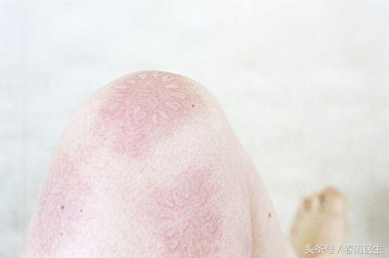 皮肤碰一下就有印子,皮肤轻轻一动就是红印子怎么回事