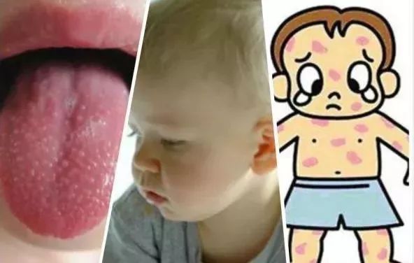 家长要小心！这种病广东进入流行高峰期，香港已拉响警报！