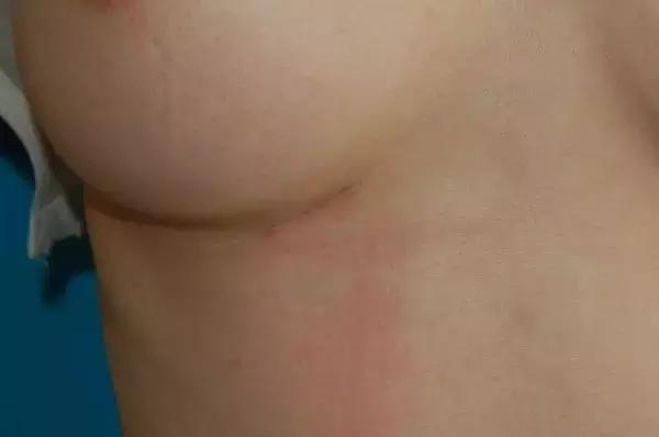 假体隆鼻都有什么术式,假体隆鼻一般用什么材料