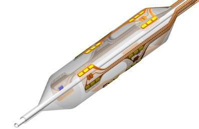 高血压肾动脉交感神经射频消融术,肾动脉消融术治疗原发高血压