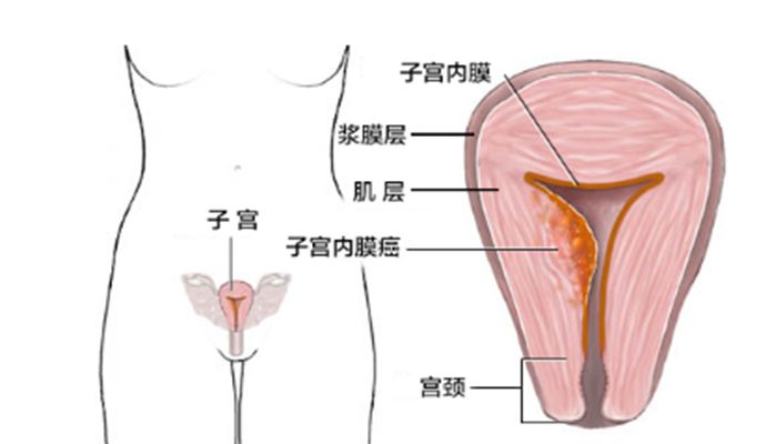 女孩因月经不调就诊，医生却让她切子宫？