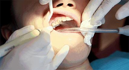 洗牙有什么副作用吗,洗牙怎么不伤牙