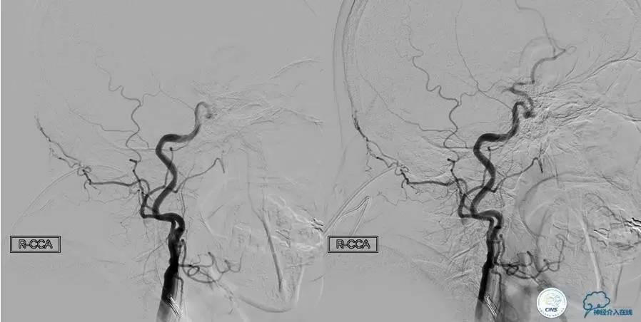 急性缺血性卒中静脉溶栓2018指南,急性缺血性卒中血管内再通标准