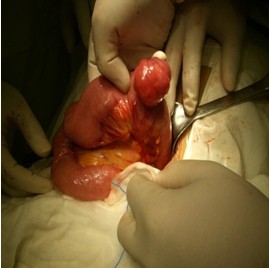 大肠癌发病率越来越高吗,小肠癌和大肠癌的症状区别