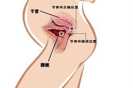 取完环二胎备孕的正式方法,备孕取环前后注意事项怎么做