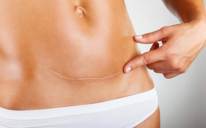 伤口怎样不留疤痕最好的方法,皮肤伤口怎么不留疤痕