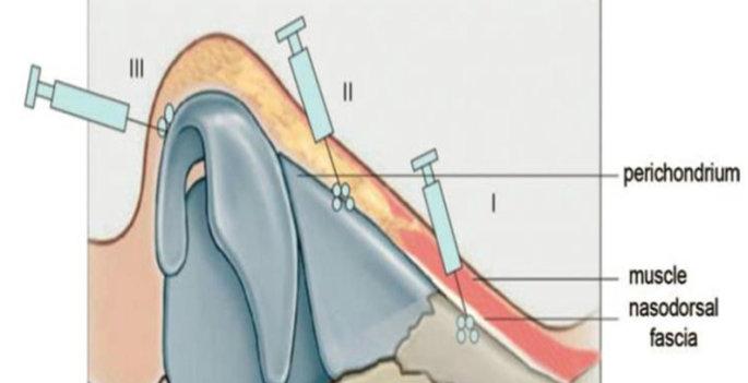 注射隆鼻的危险,注射隆鼻眼瞎