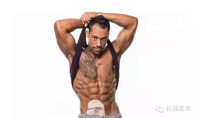 精品原创︱医生，您为什么要让我“挂粪袋”？