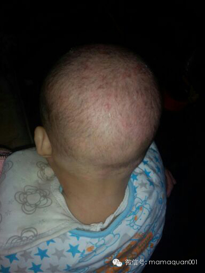 湿疹挠破皮肤感染,过敏性湿疹挠破化脓了