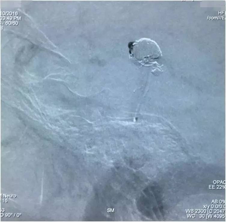 基底动脉顶端动脉瘤加左侧小脑上动脉瘤以Y型支架结合弹簧圈栓塞