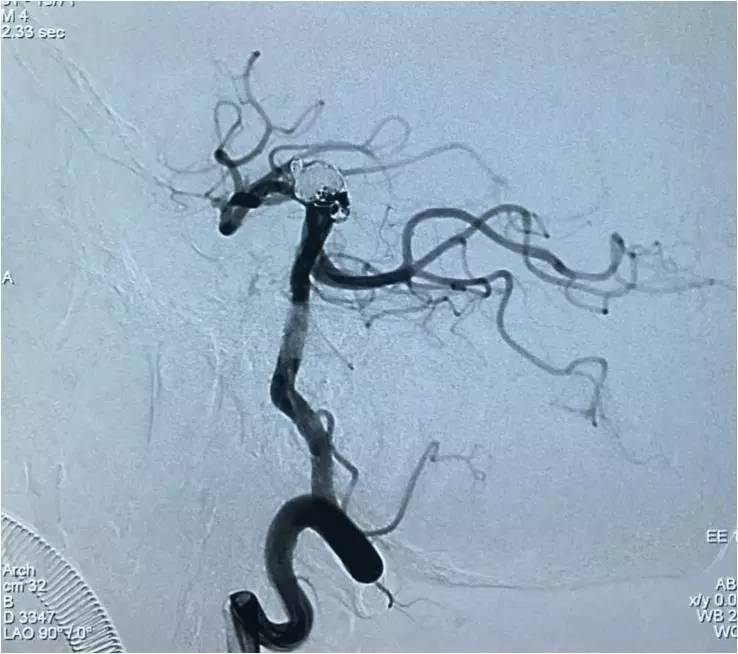 基底动脉顶端动脉瘤加左侧小脑上动脉瘤以Y型支架结合弹簧圈栓塞