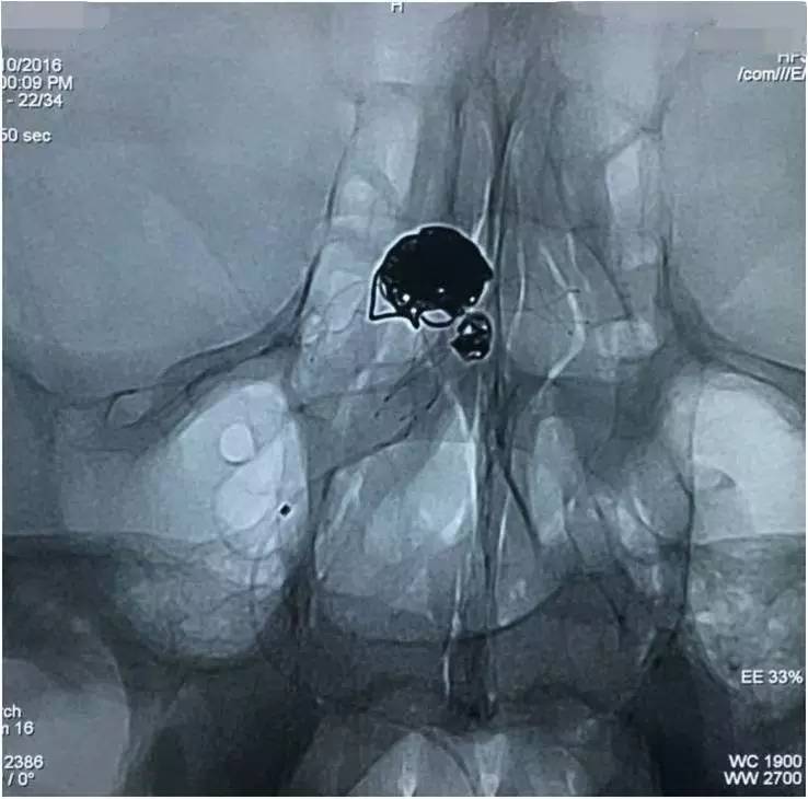基底动脉顶端动脉瘤加左侧小脑上动脉瘤以Y型支架结合弹簧圈栓塞