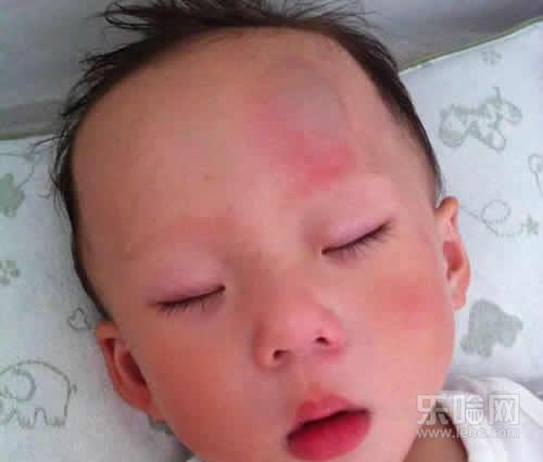 宝宝脑袋摔了包用什么药,宝宝脑袋摔了个大包