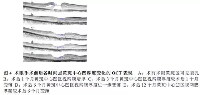 玻璃体移植,玻璃体切除联合手术