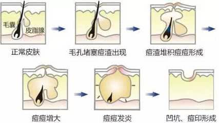 长痘的人到底有多惨如何正确祛痘,祛痘痘最好最实际的方法