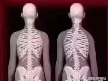 高低肩脊柱侧弯的康复手法,脊柱侧弯高低肩怎么矫正最有效