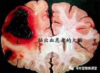 脑梗塞脑出血和中风有什么区别,脑出血脑梗塞脑血栓的区别表格