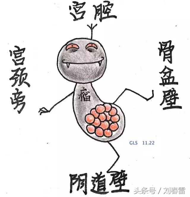 宫颈癌科普知识宣教视频,宫颈癌的科普知识宣传