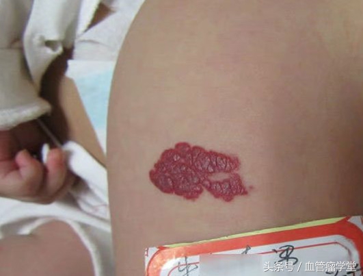 眼药水能治血管瘤是真的吗,用眼药水治血管瘤的正确使用方法