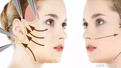 线雕小切口面雕拉皮的区别,线雕与拉皮术