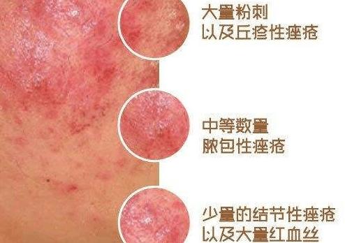 激素皮炎怎么办,激素脸皮炎最佳治疗方法