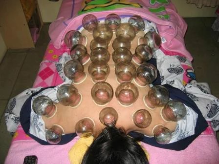 拔罐技巧视频教程全集,拔罐技巧怎么拔得更紧