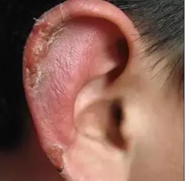 冻疮有特效膏药吗,治冻疮最快的药方