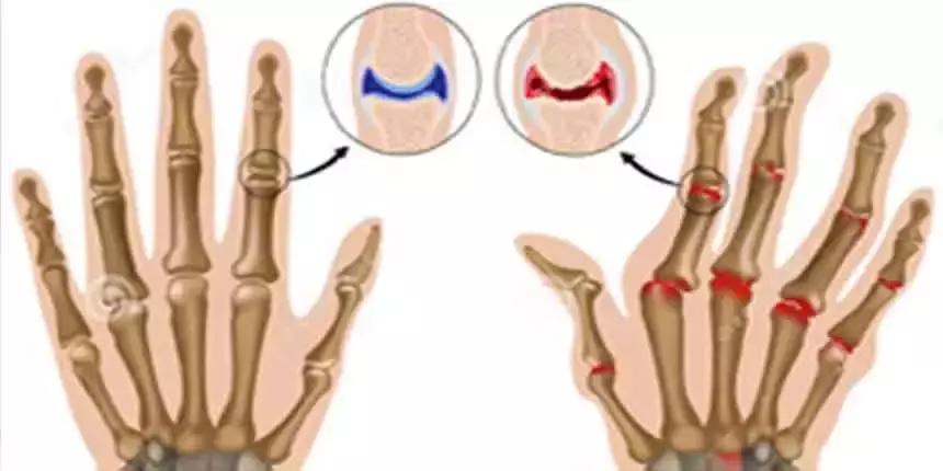 穿好奶奶织的毛裤，你依旧无法避免与风湿膏药共度晚年