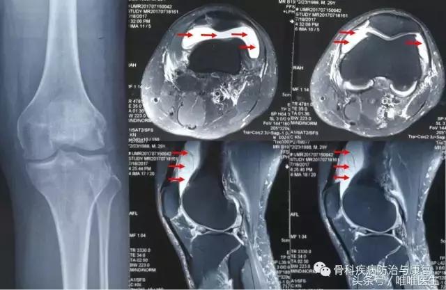 滑膜炎深度讲解（一）——华中科技大学附属协和骨科医院专家