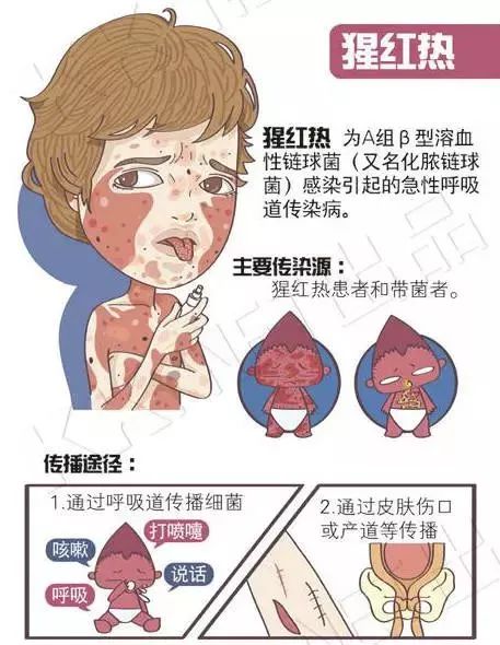 猩红热最新疫情报告发布,猩红热儿童预防