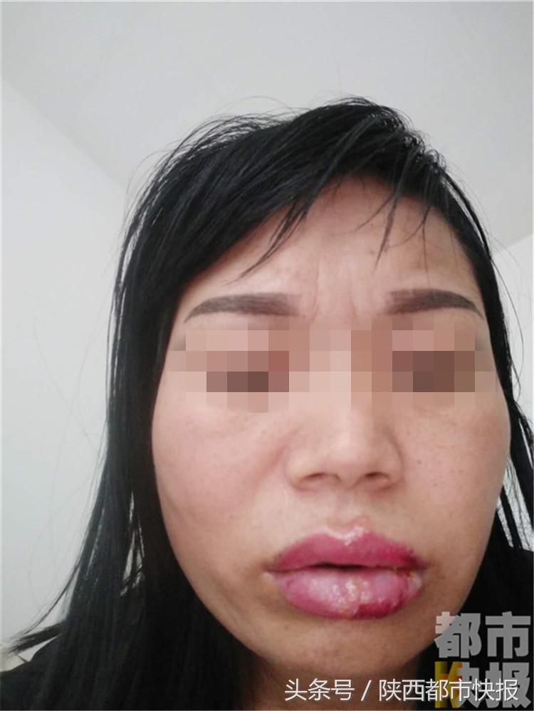 女子千元漂唇肿胀五天如“香肠”