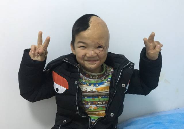 不忘初欣,奕起守护|9958「奕起祛疤童爱救助基金」救助进行中