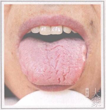 裂纹舌诊与疾病对照图,舌有裂纹六种舌象告诉你