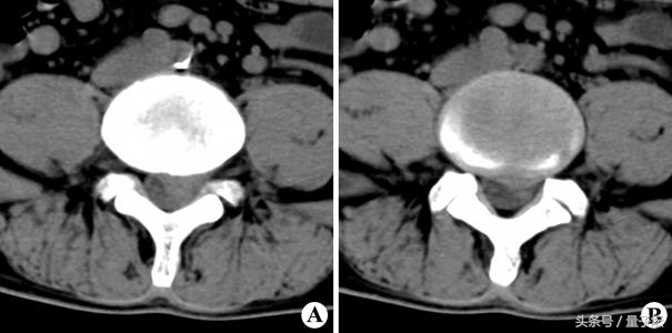 腰椎间盘突出放射到脚,放射科可以检查腰椎间盘突出吗