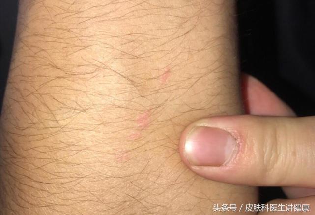 扁平疣需要治疗吗,治疗扁平疣的药膏