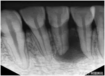 根管治疗最后补牙单独收费的吗,根管治疗最后一步需要多少钱