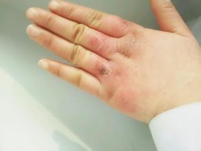 冻疮发热发痒怎么解决,天气不冷手跟冻疮一样瘙痒