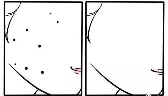 人中痣点痣过程,点痣要看痣图吗