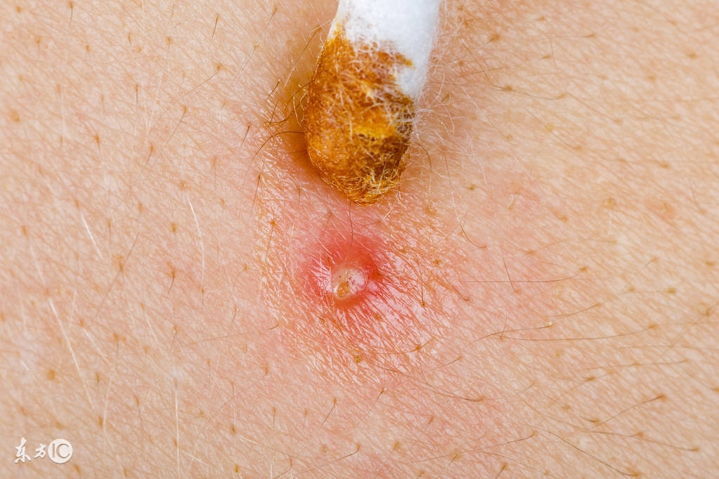 毛囊炎患者护理措施是怎样的呢