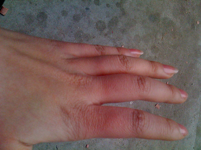 手被开水烫了要怎么处理,手被开水烫了最好的解决方法