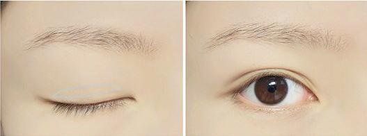 双眼皮贴总是贴的不满意,双眼皮总贴不好