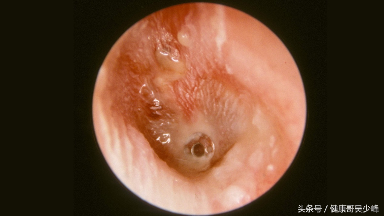 肝胆湿热引起的中耳炎该怎么治？健康哥告诉你方法来调理
